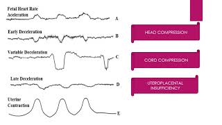 CTG INTERPRETATION [upl. by Dittman]