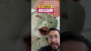 Bebés con ICTIOSIS ARLEQUÍN internista humor medicina medico enfermeria [upl. by Adekan]