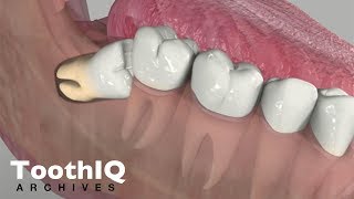 Impacted Tooth Removal [upl. by Anyd]