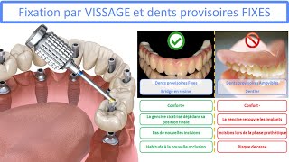 All on 4  Fixation par vissage et dents provisoires fixes [upl. by Whit]