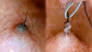 How to Prevent amp Treat Ingrown Hairs [upl. by Dael178]