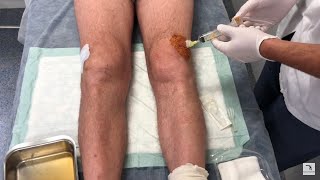 Knee effusion and arthrocentesis Swollen knee English version [upl. by Aspasia]