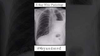 Chest XRay Normal vs Abnormal view [upl. by Nauqahs]