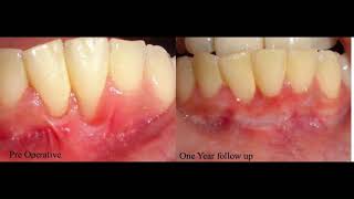 Gingival Recession Coverage with Free Gingival Graft [upl. by Crandell109]