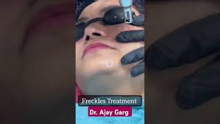 Freckles treatment instead glowing facial skinshine likeandsubscribe [upl. by Neesay818]