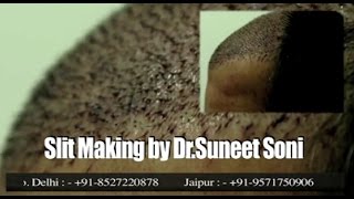 Medispa Hair Transplant Cost JaipurDelhiIndiaUSA  International Patients by Dr Suneet Soni [upl. by Nsaj99]