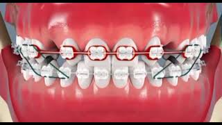 ORTHODONTIE AGÉNÉSIE DENTAIRE [upl. by Assiral]