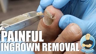 TREATING AN EXTREMELY PAINFUL INGROWN TOENAIL WITH HOW TO ADVICE [upl. by Anires]