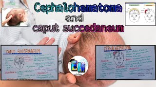 birth Injury 2 caput succedaneum and cephalohematoma  easymedicineLearning [upl. by Holland]