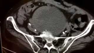 Pelvic mass [upl. by Jeffie]