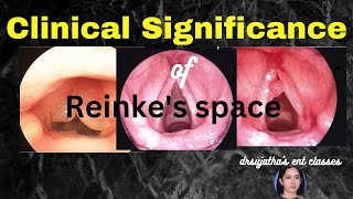 206Importance of Reinkes Space reinkes space vocalfolds clinicalexamination [upl. by Arraet]