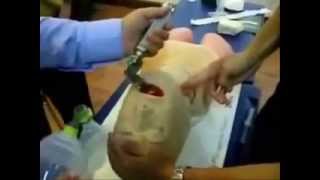 Endo Tracheal Intubationflv [upl. by Mali]