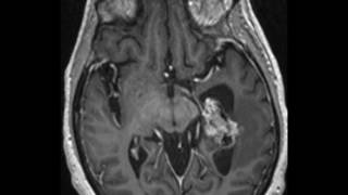 Intraventricular Metastasis [upl. by Jaret]