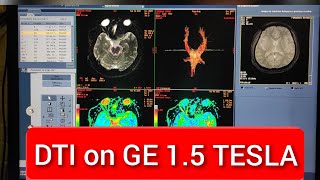 Diffusion Tensor Imaging DTI protocol positioning and planning  Live Demo in English [upl. by Friedrick]