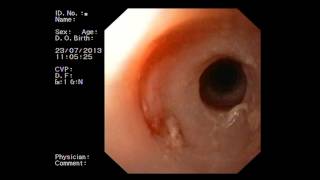 Esofagite Eosinofila Aspetti Endoscopici  Eosinophilic Esophagitis Endoscopic findings [upl. by Wojak516]