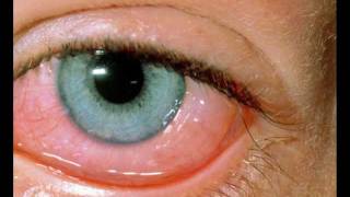 allergic conjunctivitis [upl. by Dyke]