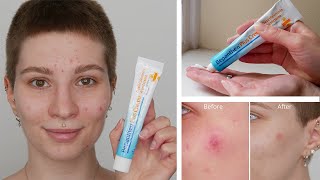 How to treat a minor burned wound with Bepanthen Plus Antiseptic Wound Healing Cream [upl. by Ecille]