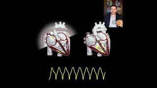 Wide vs Narrow QRS complex in Arrhythmias Shorts [upl. by Farmann]