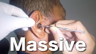 Removing Officers Massive Impacted Earwax without Earwax Softener [upl. by Jamin419]