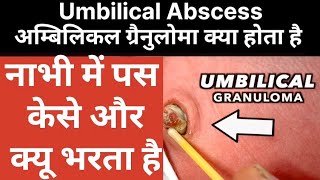 umbilical Abscess umbilical granuloma doctor viralvideo medical students surgeon mbbs [upl. by Arammahs]