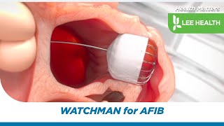 WATCHMAN for AFIB [upl. by Nonaihr]