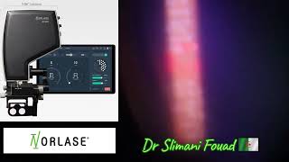 laser norlase écho multispots micropulse [upl. by Finbur]