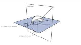 Anteversion and inclination of an acetabular cup [upl. by Maggio]