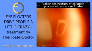 VITREOUS EYE FLOATER Destruction with a laser because floaters drive people a little crazy [upl. by Annemarie284]