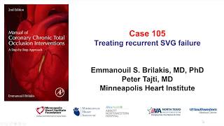 Case 105 Manual of CTO Interventions  Recurrent SVG failure [upl. by Rehctaht]