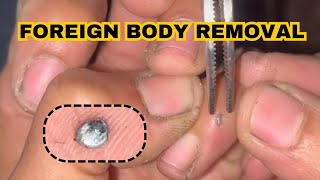 Foreign body removal from hand [upl. by Yeblehs]