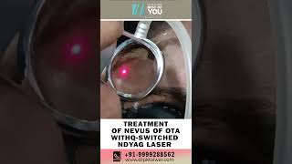 Treatment of Nevus of Ota with Laser  Birthmark Removal Treatment with Laser  Dr PK Talwar [upl. by Yaniv]