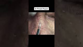 Nose Blackheads To Start Your Weekend shorts [upl. by Aikemehs750]