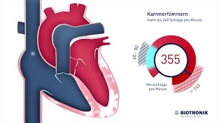 Kammerflimmern amp plötzlicher Herztod Animation [upl. by Sybille]