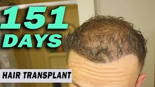 FUE Hair Transplant 151 Days post op Istanbul Turkey GROWTH STAGE [upl. by Aleibarg]