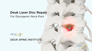 Cervical Deuk Laser Disc Repair DLDR for Discogenic Neck Pain  3D Animation [upl. by Lowry]