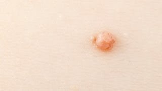 Skin Tags  How To Get Rid Of Them What Causes Them What Are They [upl. by Brandenburg91]