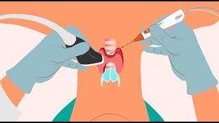 Radiofrequency Thyroid Ablation StarMed  English [upl. by Nosreve]