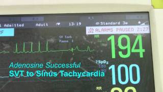 SVT or Supraventricular Tachycardia [upl. by Asoj]