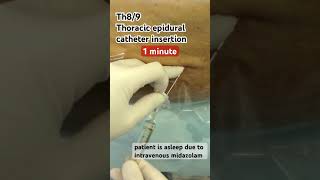 1 minTh89 thoracic epidural anesthesia catheter insertion by DrEpiCal 1分で硬膜外麻酔カテーテル留置 shorts [upl. by Hairahs]