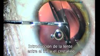 Lente intraocular para el tratamiento de la miopia hipermetropia y astigmatismo [upl. by Aidualc33]