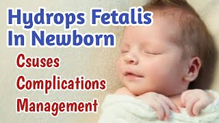 Hydrops Fetalis In Newborn Baby  Fetal Hydrops Causes Complications Treatment amp Prognosis [upl. by Anaul]