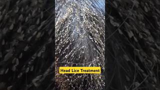 Get rid of Head LICE and EGGS headliceremoval headlice shorts dadumedicalcentre [upl. by Kare]