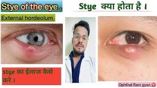 whats are stye  cause  signs and symptoms and Treatment [upl. by Adiv]