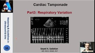 Cardiac tamponade Part 3 Respiratory Variation [upl. by Rafferty]