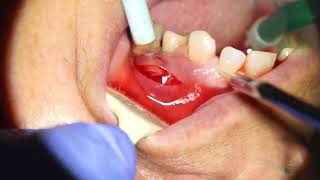 TOOTH ABSCESS DRAINAGE [upl. by Shandee195]