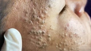 Blackheads amp Whiteheads Satisfying Removal 0033 [upl. by Oruam]