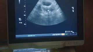 Osseous metaplasia uterus pelvicultrasound pathology [upl. by Stephanus962]