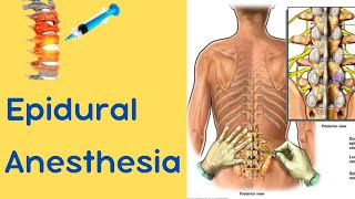 Epidural Anesthesia [upl. by Aremmat]