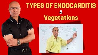 Endocarditis Types and Vegetations  Cardiology🫀 [upl. by Llerrah851]