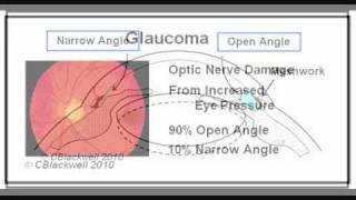 Glaucoma 3 Narrow Angle [upl. by Bruyn425]